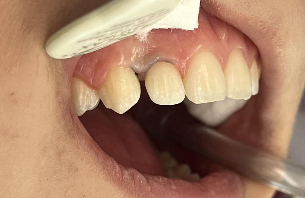 Przed leczeniem Przed leczeniem