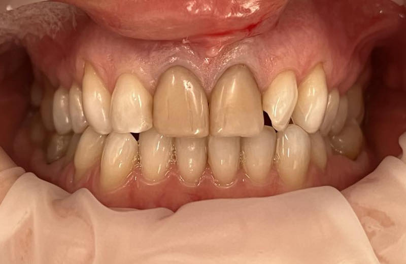Przed leczeniem Przed leczeniem
